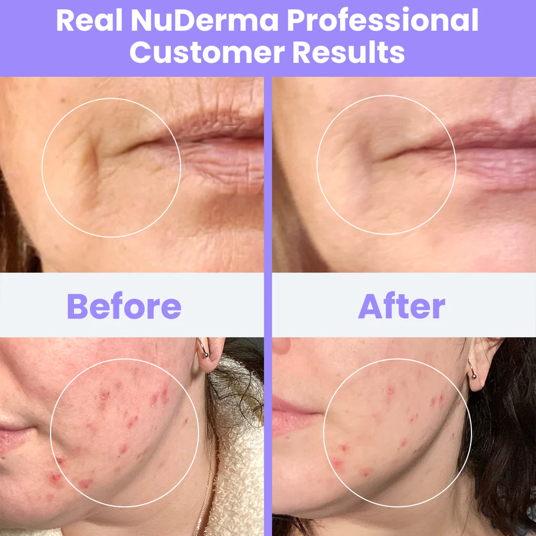 The Professional Wand That Does Both: Clear Skin + Anti-Aging